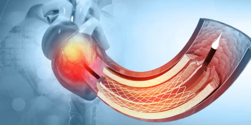 Coronary Angiography in Pune