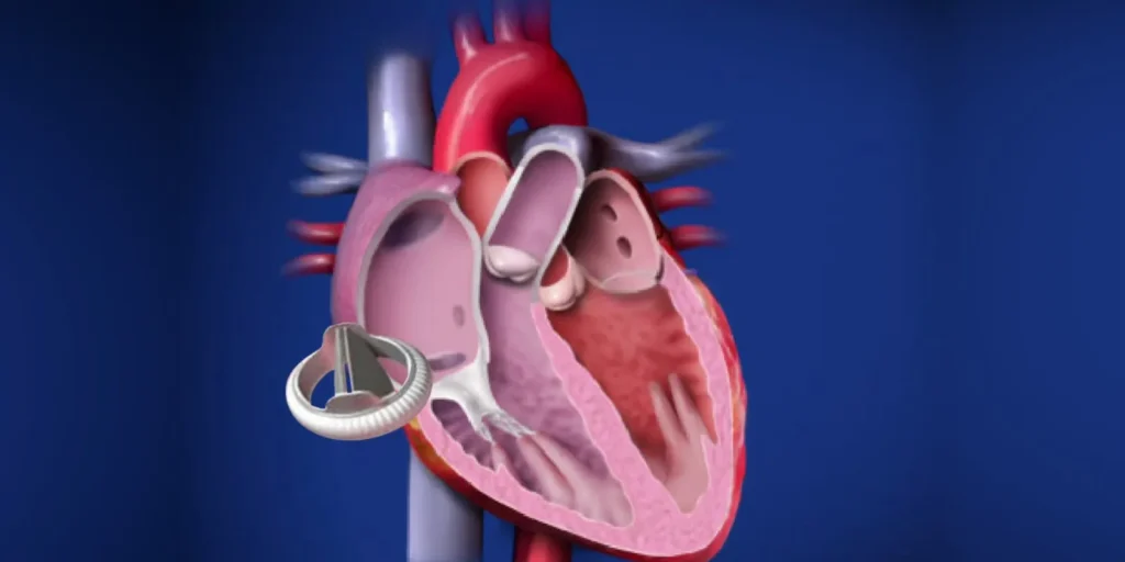 Heart Valve Replacement Surgery