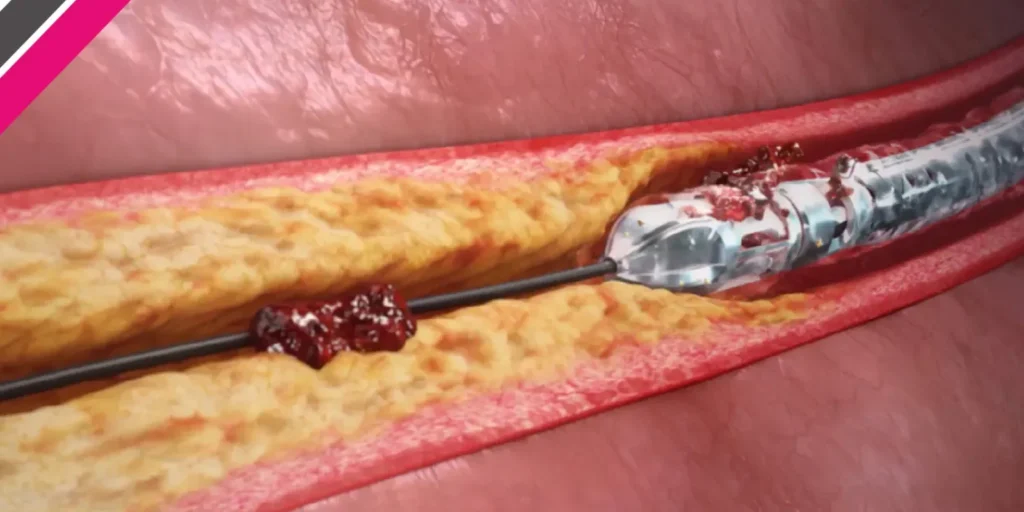Rotational Atherectomy