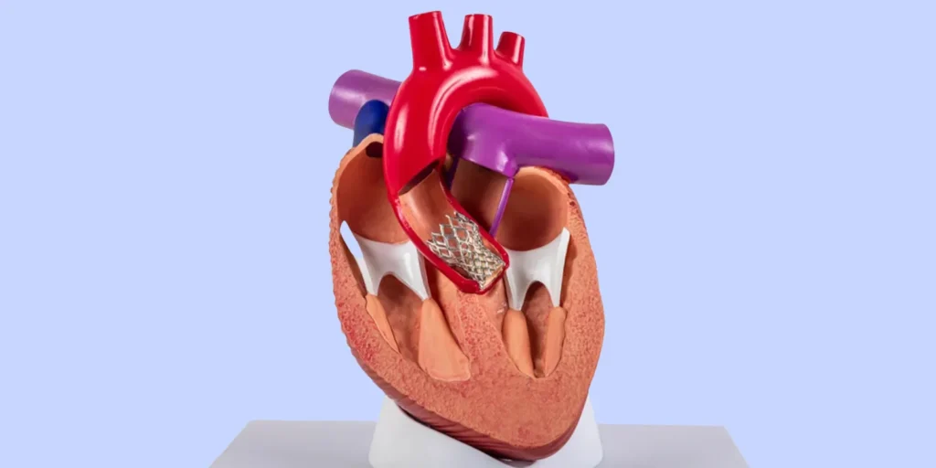 Transcatheter Aortic Valve ImplantationReplacement